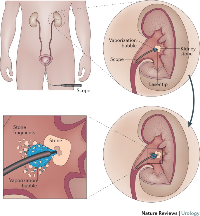 Evaluation Of Dusting Versus Basketing Can New Technologies Improve Stone Free Rates Nature Reviews Urology