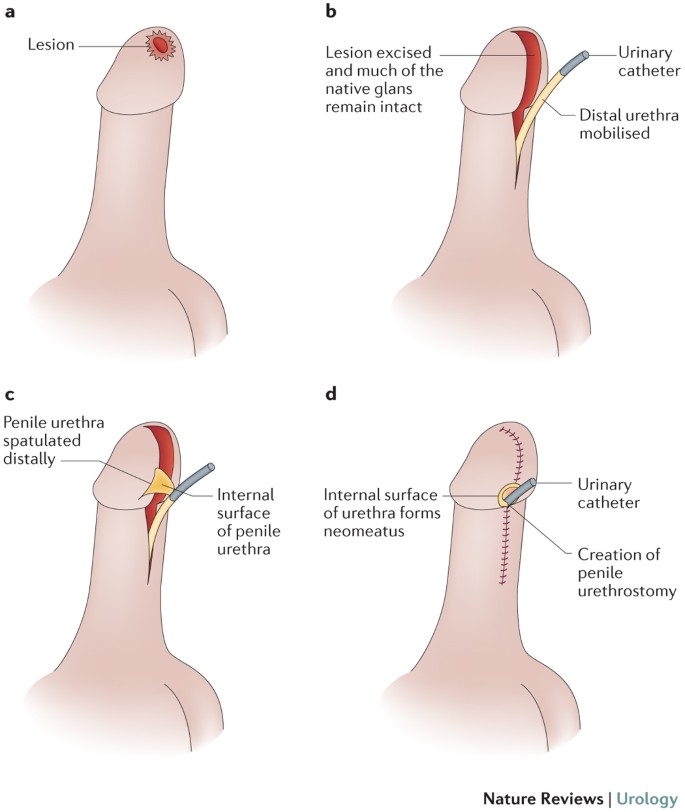 penile cancer early signs