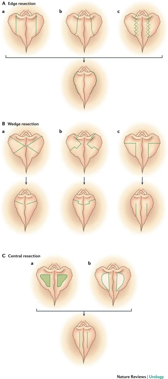 labiaplasty Labiaplasty: motivation, techniques, and ethics | Nature Reviews Urology