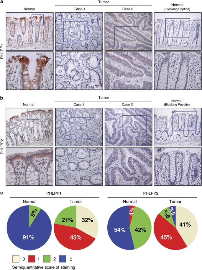 Loss Of Phlpp Expression In Colon Cancer Role In Proliferation And Tumorigenesis Oncogene