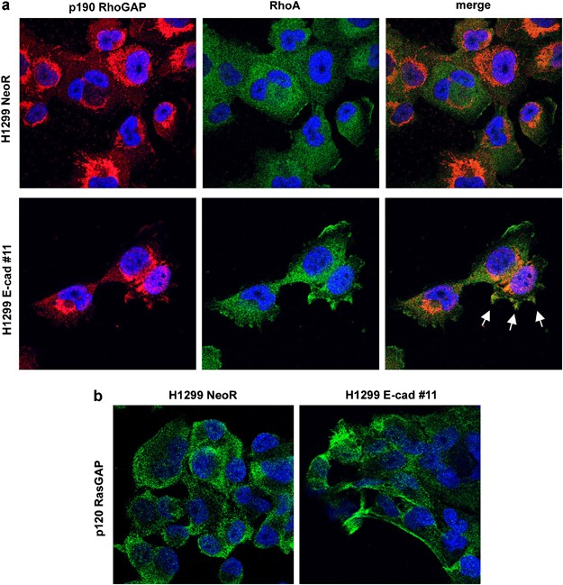 E Cadherin Negatively Regulates Neoplastic Growth In Non Small Cell Lung Cancer Role Of Rho Gtpases Oncogene