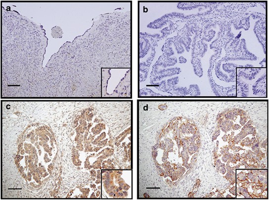Identification Of Salt Inducible Kinase 3 As A Novel Tumor Antigen Associated With Tumorigenesis Of Ovarian Cancer Oncogene
