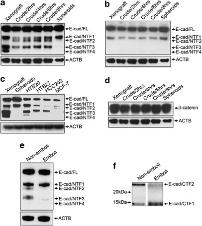 The Genesis And Unique Properties Of The Lymphovascular Tumor Embolus Are Because Of Calpain Regulated Proteolysis Of E Cadherin Oncogene