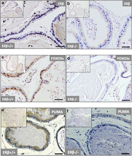 Estrogen receptor β upregulates FOXO3a and causes induction of apoptosis  through PUMA in prostate cancer | Oncogene