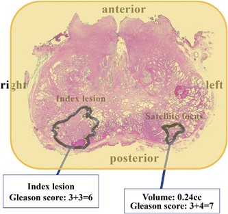 Histological Characteristics Of The Index Lesion In Whole Mount Radical Prostatectomy Specimens Implications For Focal Therapy Prostate Cancer And Prostatic Diseases
