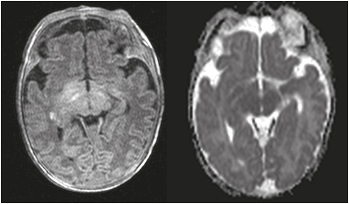 Scoring System For Periventricular Leukomalacia In Infants With Congenital Heart Disease Pediatric Research
