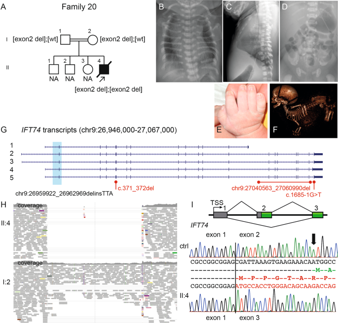 High Diagnostic Yield In Skeletal Ciliopathies Using Massively Parallel Genome Sequencing Structural Variant Screening And Rna Analyses Journal Of Human Genetics