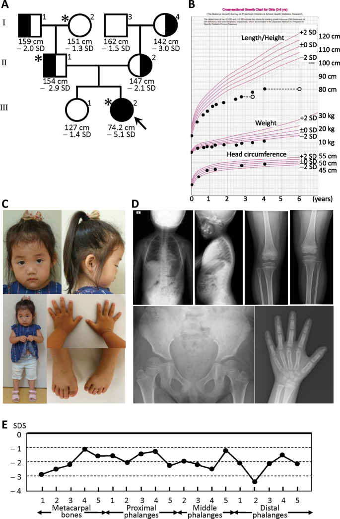ACAN biallelic variants in a girl with severe idiopathic short stature |  Journal of Human Genetics