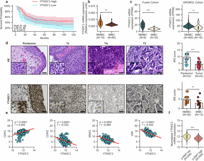 Fig. 1: YTHDC1 is downregulated and associated with metastatic potential in urothelial carcinoma of the bladder.