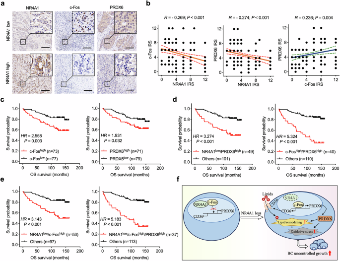 Fig. 8: The impact of NR4A1–c-Fos–PRDX6 axis on BC prognosis.