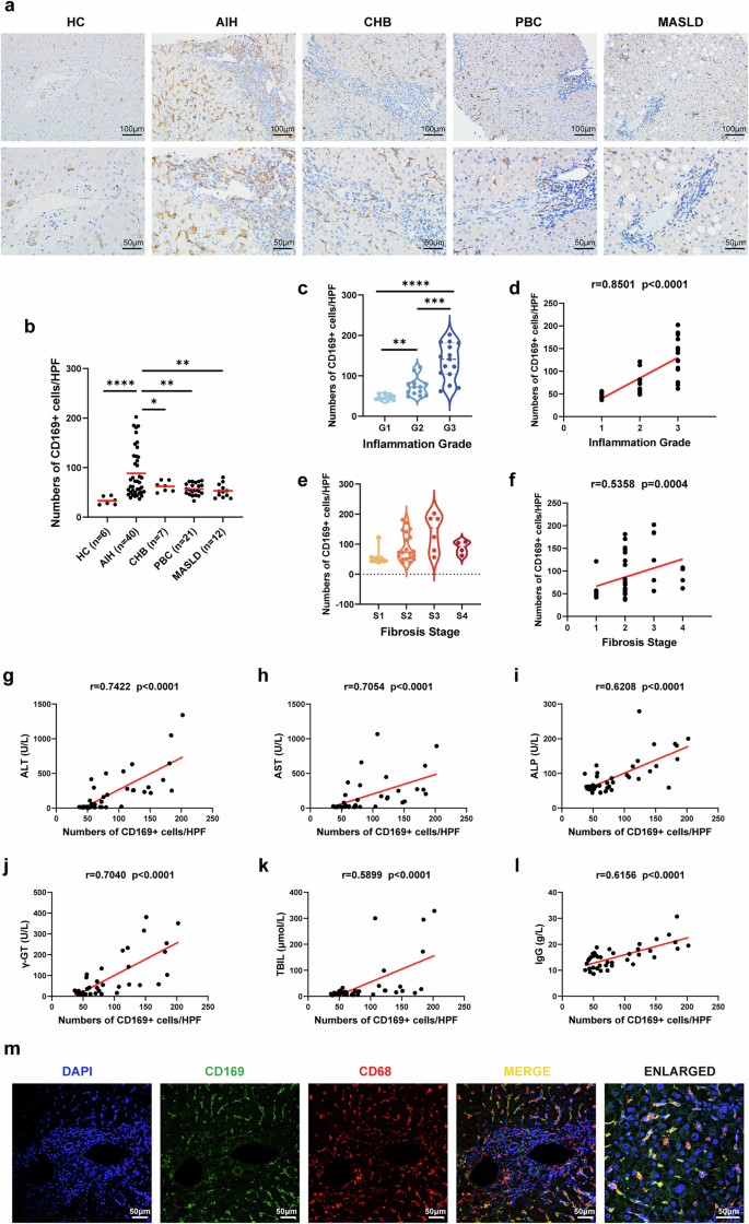 Fig. 1: CD169+ macrophages increased in the liver of patients with AIH.