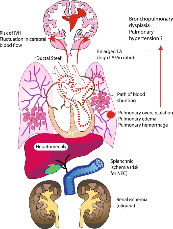 pda neonate