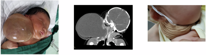 Fig. 1: Macrocystic neck lymphatic malformation treated with bleomycin (two procedures in total).