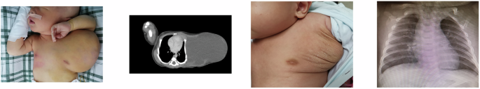Fig. 2: Mixed-type lymphatic malformation at chest wall with chest wall compression treated with bleomycin and polidocanol (three procedures in total).