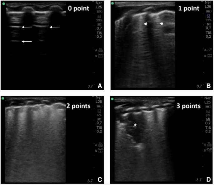 Fig. 1: Lung ultrasound scoring and sonographic appearance.