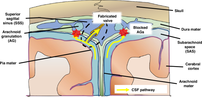 Fig. 1: Illustration of alternative methods for CSF drainage in the treatment of hydrocephalus when arachnoid granulations (AGs) fail to regulate CSF flow.