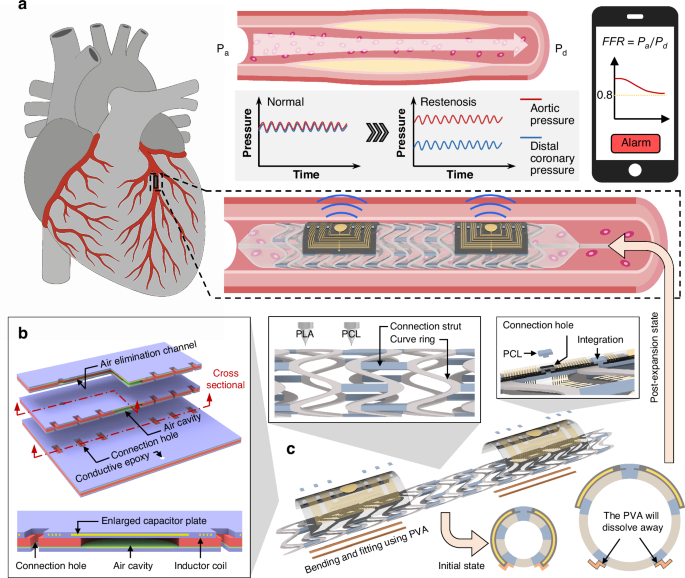 Fig. 1: Schematic illustration of the bioresorbable smart stent for continuous hemodynamic sensing and FFR monitoring.