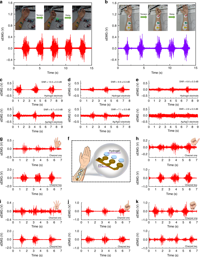 Fig. 4: Acquisition of sEMG signals using PCGK-CT hydrogel.
