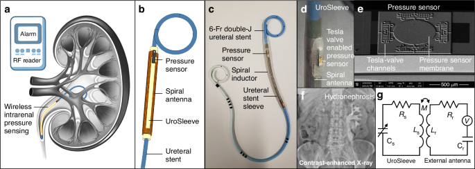 Fig. 1: UroSleeve concept, device architecture, and wireless pressure sensing principle.