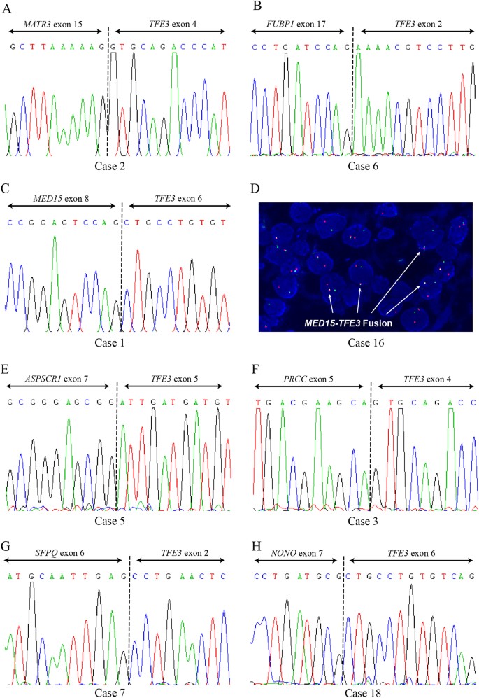 Rna Sequencing Of Xp11 Translocation Associated Cancers Reveals Novel Gene Fusions And Distinctive Clinicopathologic Correlations Modern Pathology Rna Sequencing Of Xp11 Translocation Associated Cancers Reveals Novel Gene Fusions And Distinctive Clinicopathologic Correlations Modern Pathology