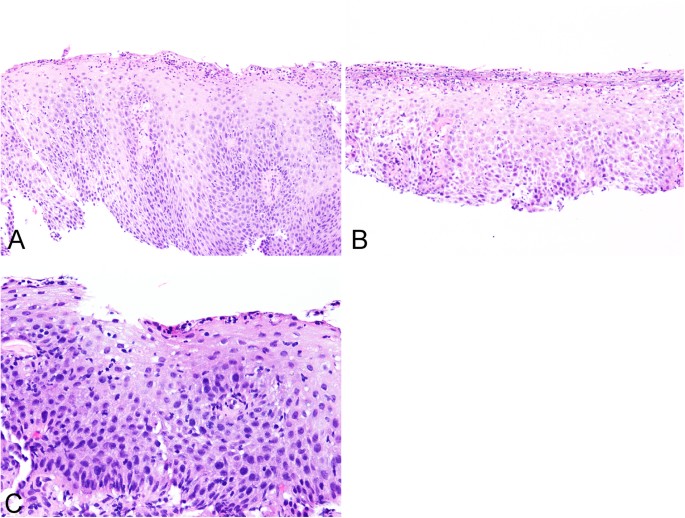 candida esophagitis