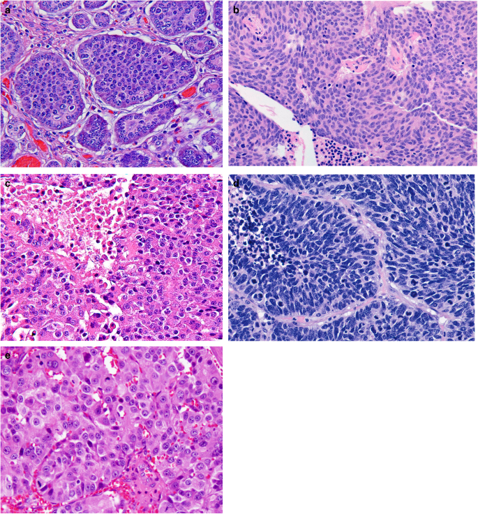 neuroendocrine cancer neck