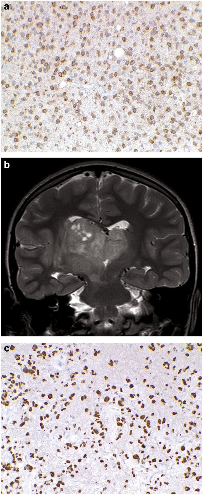 anaplastic astrocytoma versus dmg anaplastic astrocytoma versus dmg