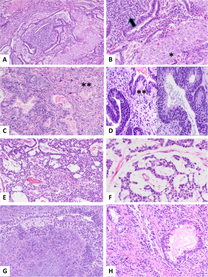 Endometrial tumors with yolk sac tumor-like morphologic patterns or  immunophenotypes: an expanded appraisal | Modern Pathology