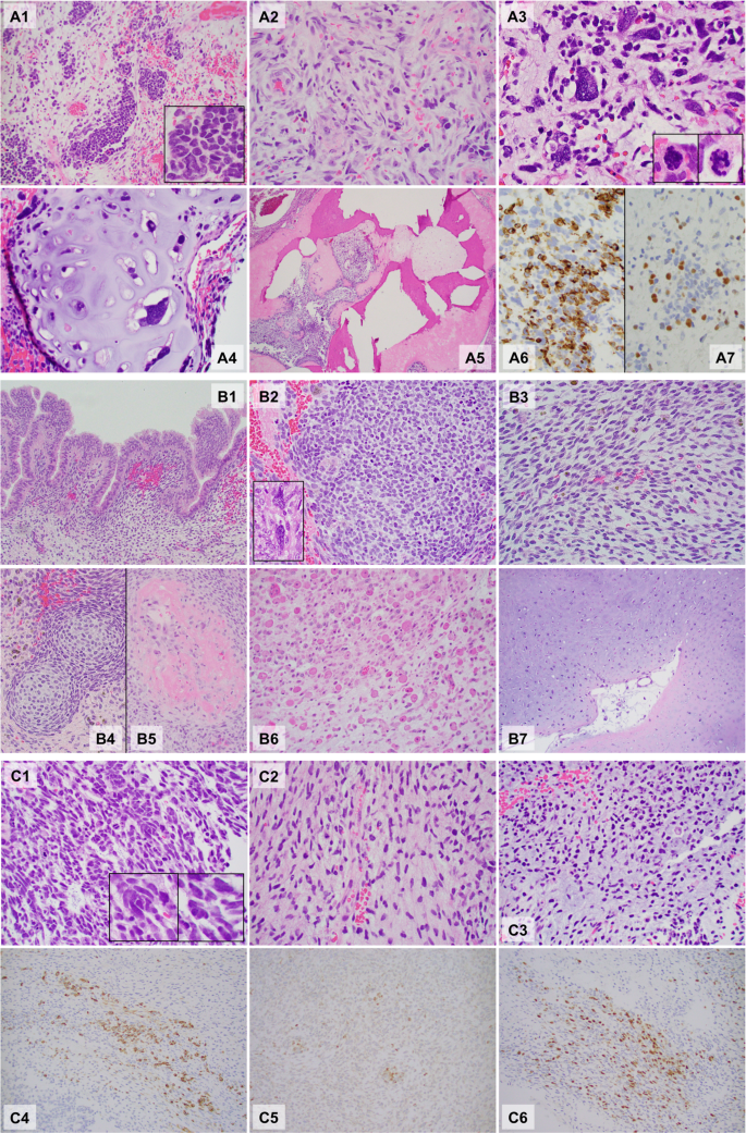 Expanding The Spectrum Of Dicer1 Associated Sarcomas Modern Pathology