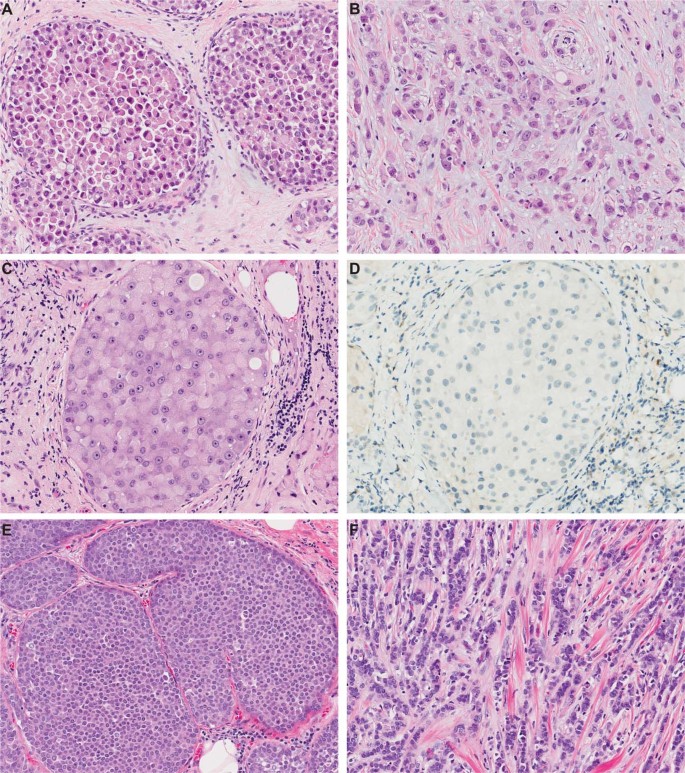 Genetic analysis of pleomorphic and florid lobular carcinoma in situ  variants: frequent ERBB2/ERBB3 alterations and clonal relationship to  classic lobular carcinoma in situ and invasive lobular carcinoma | Modern  Pathology