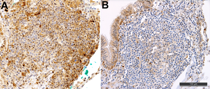 Fig. 4: Follicular bronch(iol)itis with PTEN mutation.