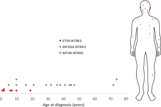 Fig. 1: Age at diagnosis and anatomic distribution of NTRK3-fused Spitz tumors.
