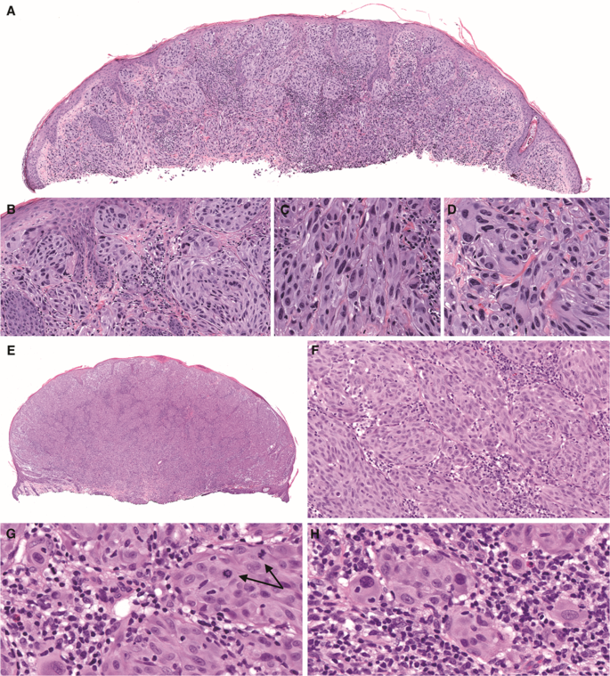 Fig. 2: Spitz melanocytomas (atypical Spitz tumors) with ETV6-NTRK3 fusion.