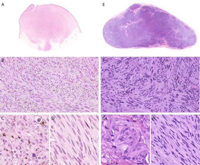 Fig. 4: Melanomas with MYO5A-NTRK3 fusion demonstrate nodules of spindled melanocytes with a fascicular growth pattern and areas of marked cytologic atypia.