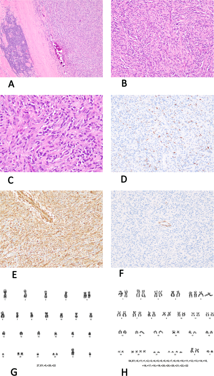 Inflammatory Leiomyosarcoma And Histiocyte Rich Rhabdomyoblastic Tumor A Clinicopathological Immunohistochemical And Genetic Study Of 13 Cases With A Proposal For Reclassification As Inflammatory Rhabdomyoblastic Tumor Modern Pathology