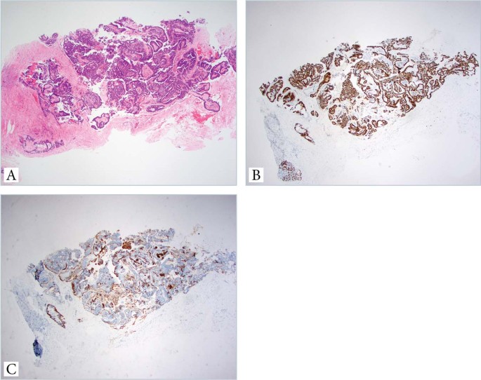 orr papilloma diagnózis