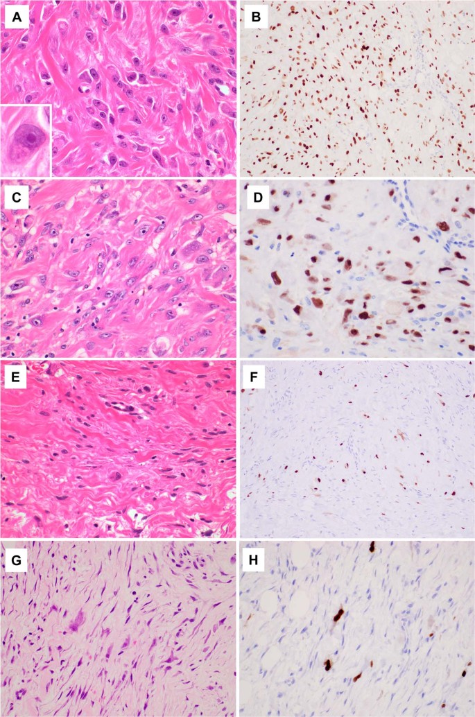 Fig. 2: Histological and c-FOS immunohistochemical findings of proliferative fasciitis.