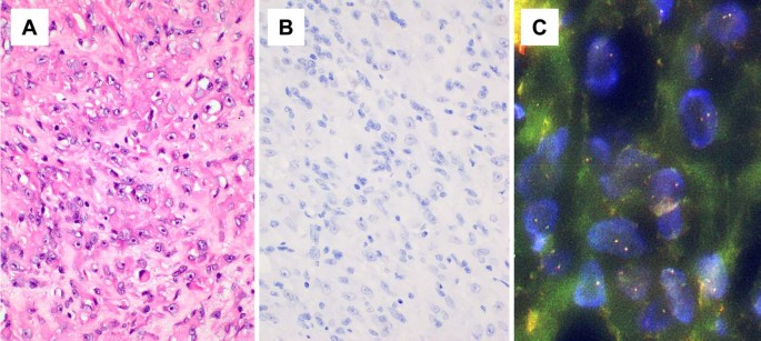 Fig. 7: A pediatric case of proliferative fasciitis (case 3).