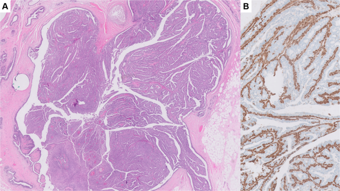 Intraductalis papilloma lcisszel