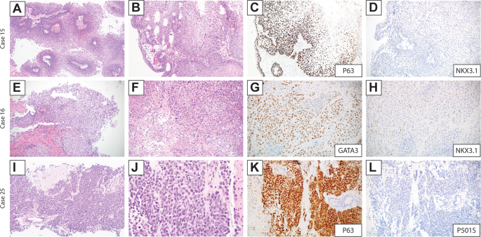 prostate vs urothelial carcinoma immunohistochemistry