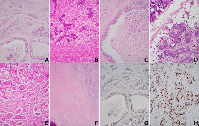 Fig. 1: Morphologic spectrum of salivary duct carcinoma (SDCa) included in this study.