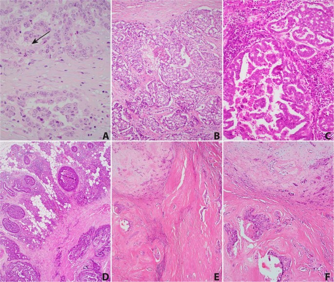 Fig. 2: Morphologic spectrum of AR negative cases.
