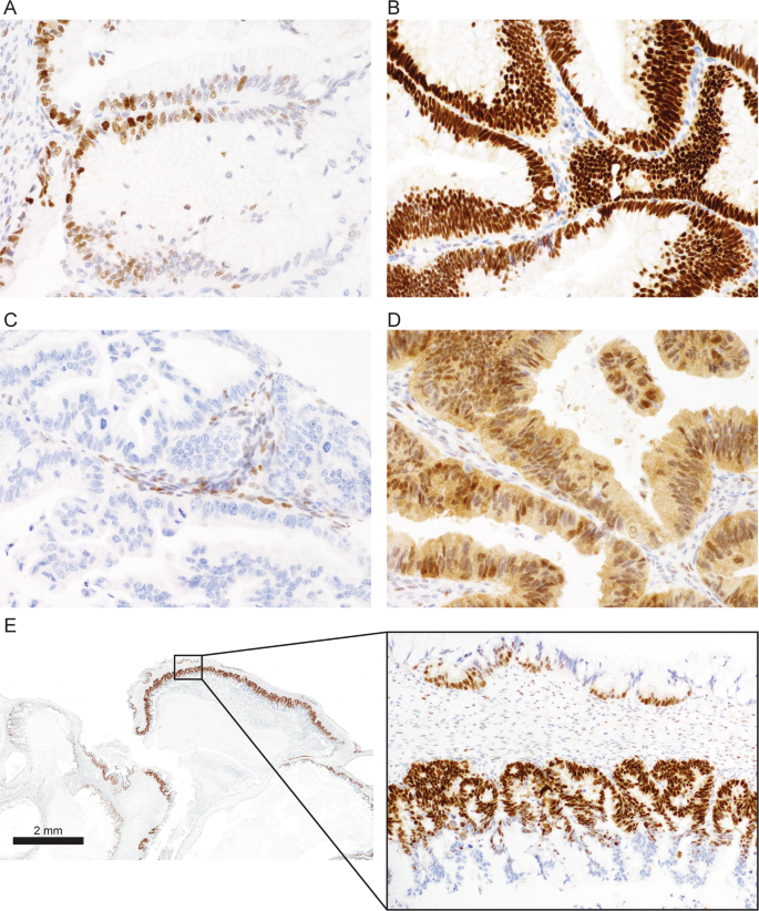 Fig. 1: TP53 immunohistochemistry staining patterns.