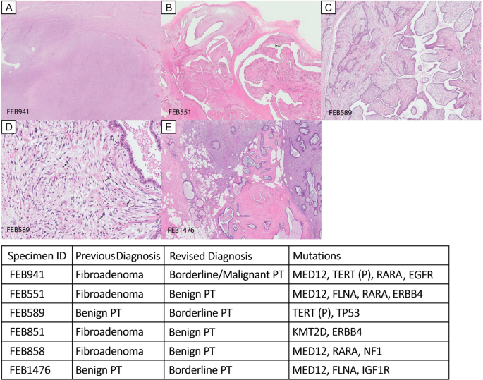 Genetic Differences Between Benign Phyllodes Tumors And Fibroadenomas Revealed Through Targeted Next Generation Sequencing Modern Pathology
