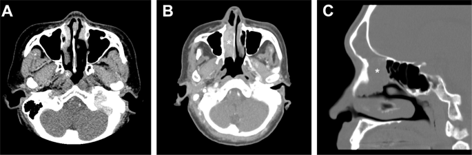 Fig. 1: CT (computed tomography) scans of DEK-AFF2 fusion-associated papillary squamous cell carcinoma with deceptively bland morphology.