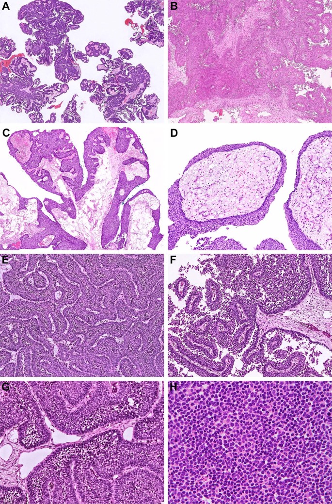 Fig. 2: Major diagnostic features of DEK-AFF2 fusion-associated papillary squamous cell carcinoma with deceptively bland morphology.