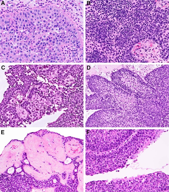 Fig. 3: Other peculiar morphologic features of DEK-AFF2 fusion-associated papillary squamous cell carcinoma with deceptively bland morphology.