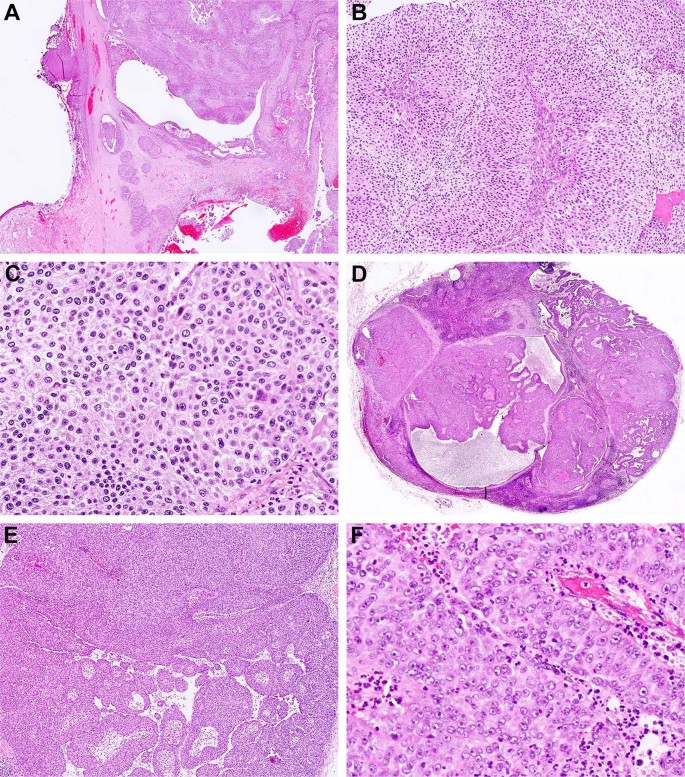 Fig. 4: Morphological progression of DEK-AFF2 fusion-associated papillary squamous cell carcinoma with deceptively bland morphology.