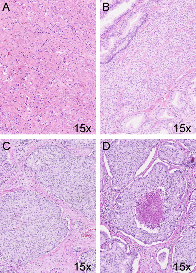 adenocarcinoma prostate gleason 6( 33)