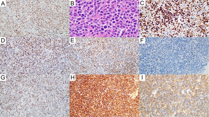 Fig. 1: Mantle cell lymphoma (MCL) with EZH2 expression (EZH2+ MCL).